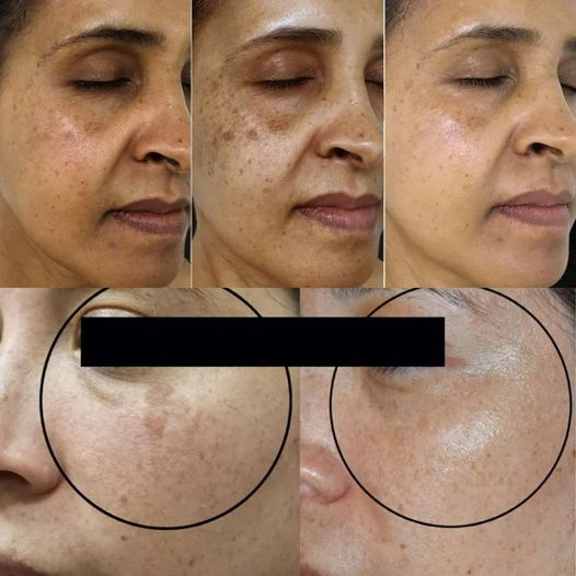 This Vitamin Removes Age Spots Permanently(ALWAYS Works)