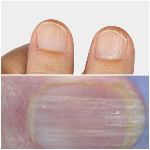 Unveiling the Mystery Behind Vertical Ridges on Nails