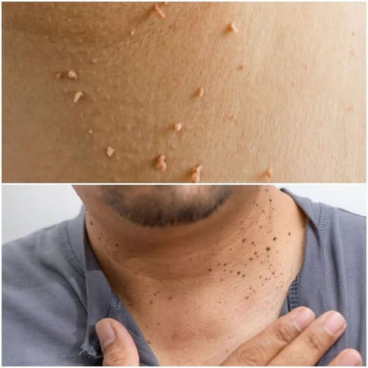 Easy Home Remedies for Skin Tags and Plantar Warts