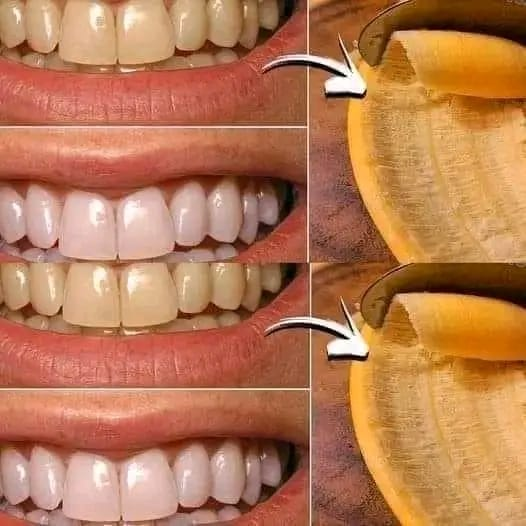 Remove Tartar and Teeth Whitening in just 2 minutes