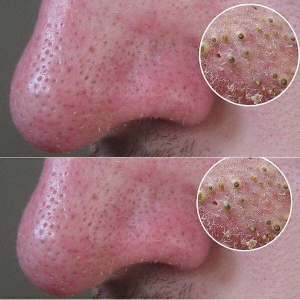 The 5 most effective remedies to remove blackheads in no time