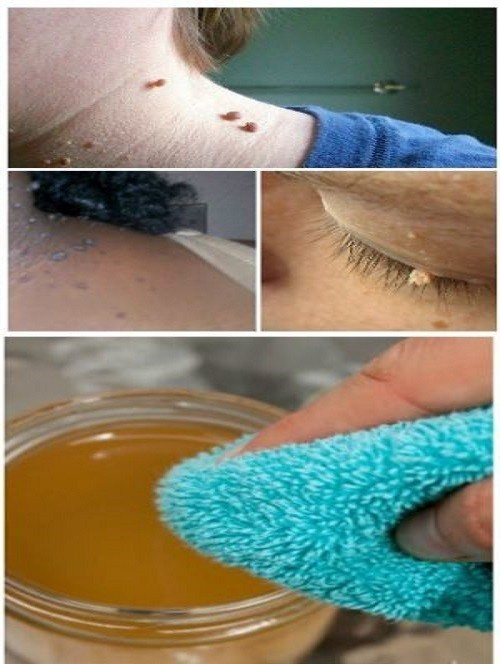 It is possible to eliminate all warts, black spots, pimples, pores, and skin tags in a short period of time by using natural remedies that have been shown to be efficient; this may be accomplished.